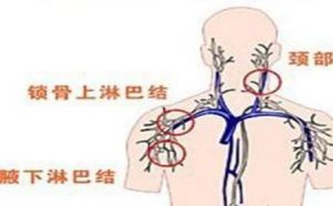 依魯替尼治療巨球蛋白血癥的療效